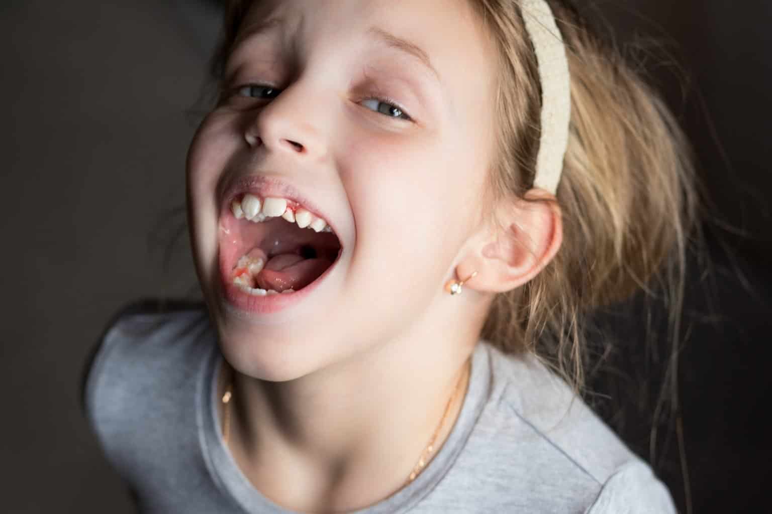 Cuando los dientes de leche no se caen Criar con Sentido Común