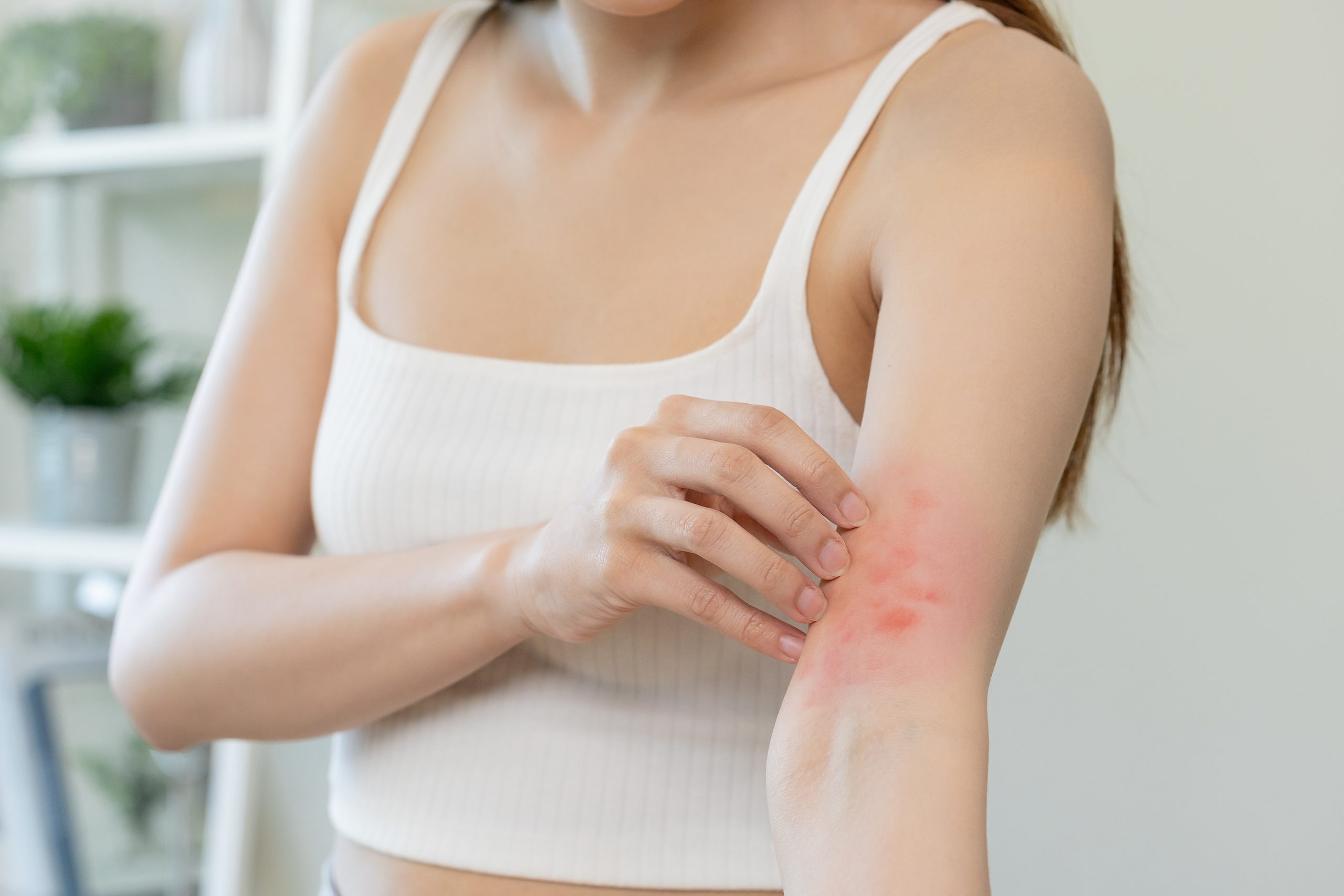 De vuelta a las aulas Los adolescentes con dermatitis atópica tienen más probabilidades de sufrir acoso