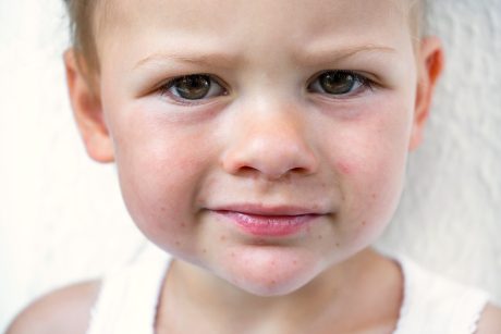 Virus Coxsackie en niños - Criar con Sentido Común